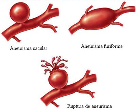 Aneurismas Arteriais