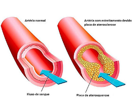 Arterioesclerose
