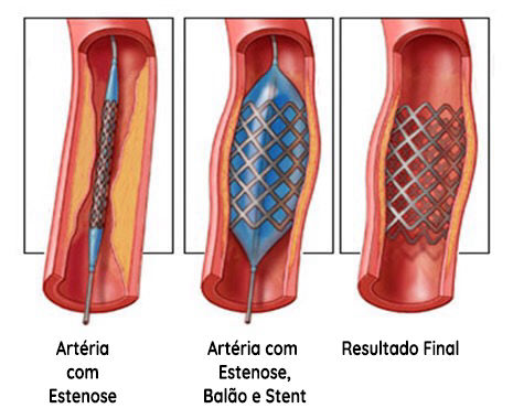 AVC - Acidente Vascular Cerebral